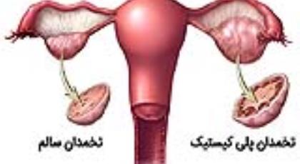 سندرم تخمدان پر کیست(PCO)یاتنبلی تخمدان